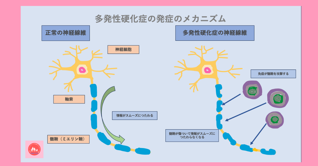 multiple-sclerosis-cure