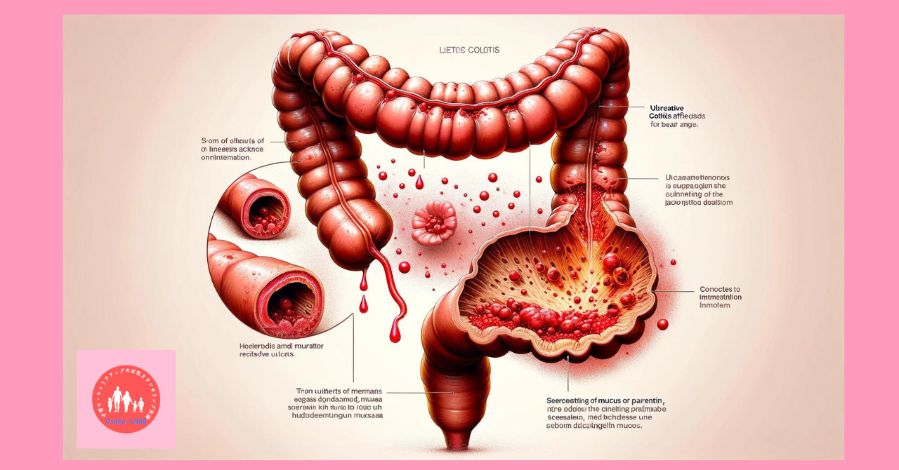 ulcerative-colitis-treatment