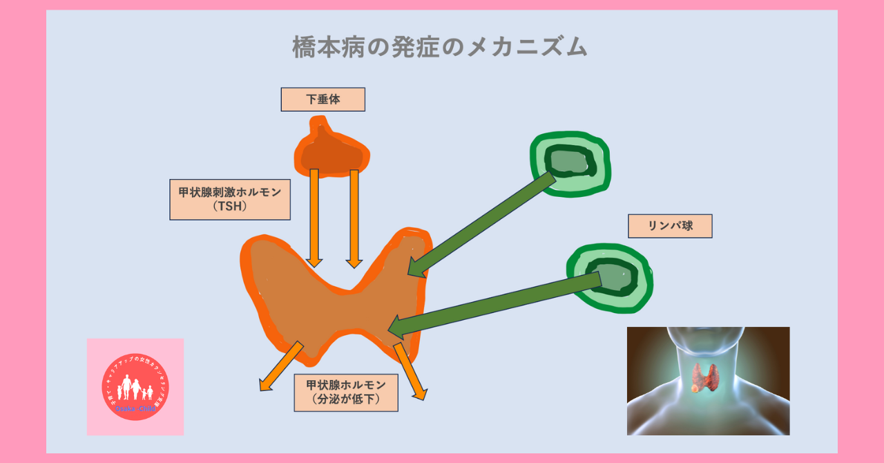 stress-hashimotos-disease