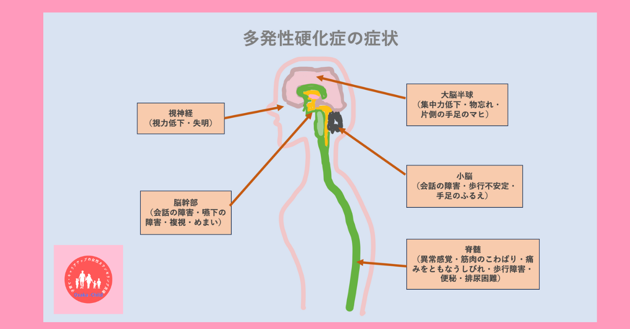 multiple-sclerosis-cure