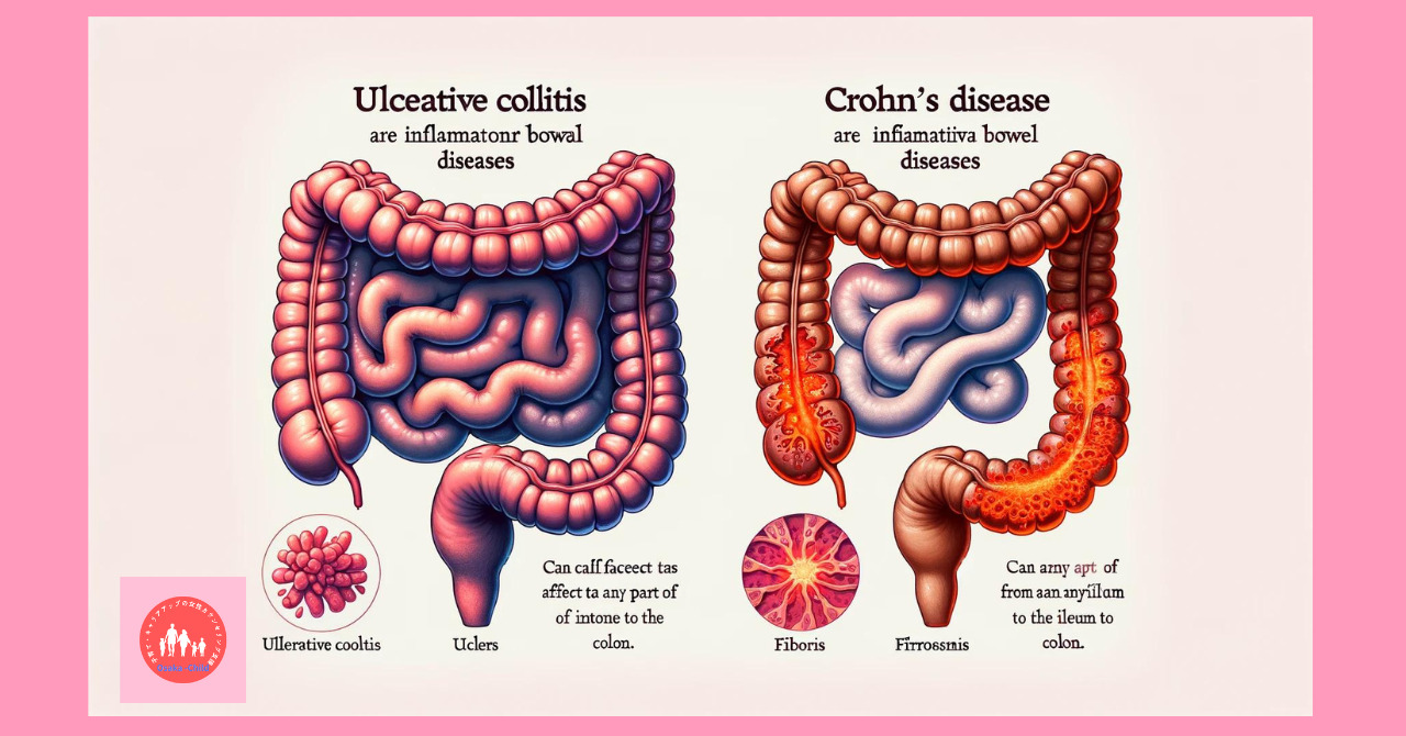 ulcerative-colitis-treatment