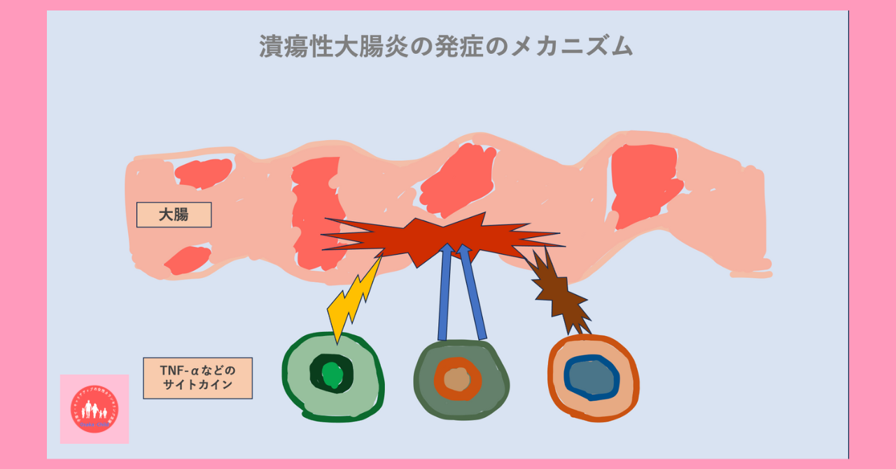 ulcerative-colitis-treatment